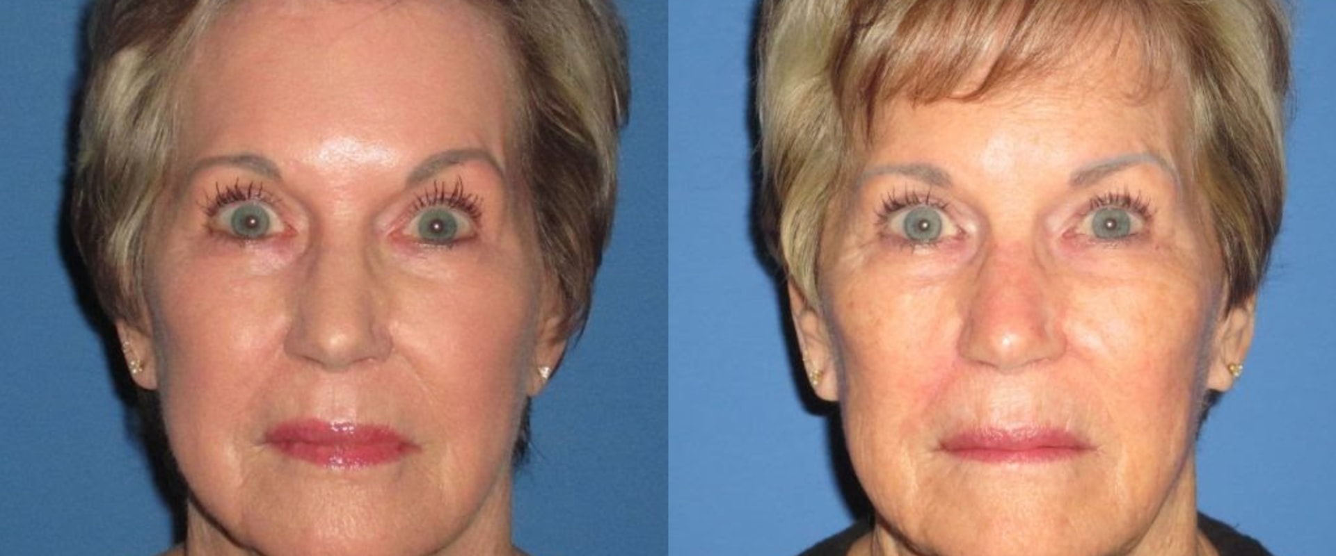 Is 70 too old for face-lift?