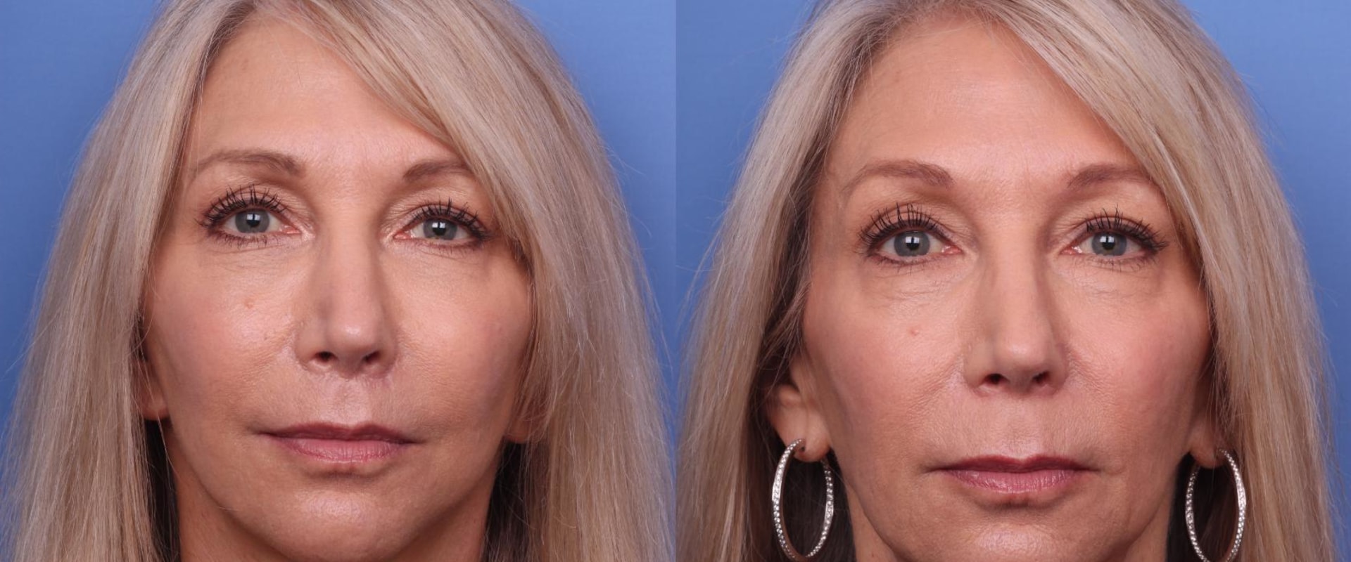 Can cosmetic surgery make you look younger?