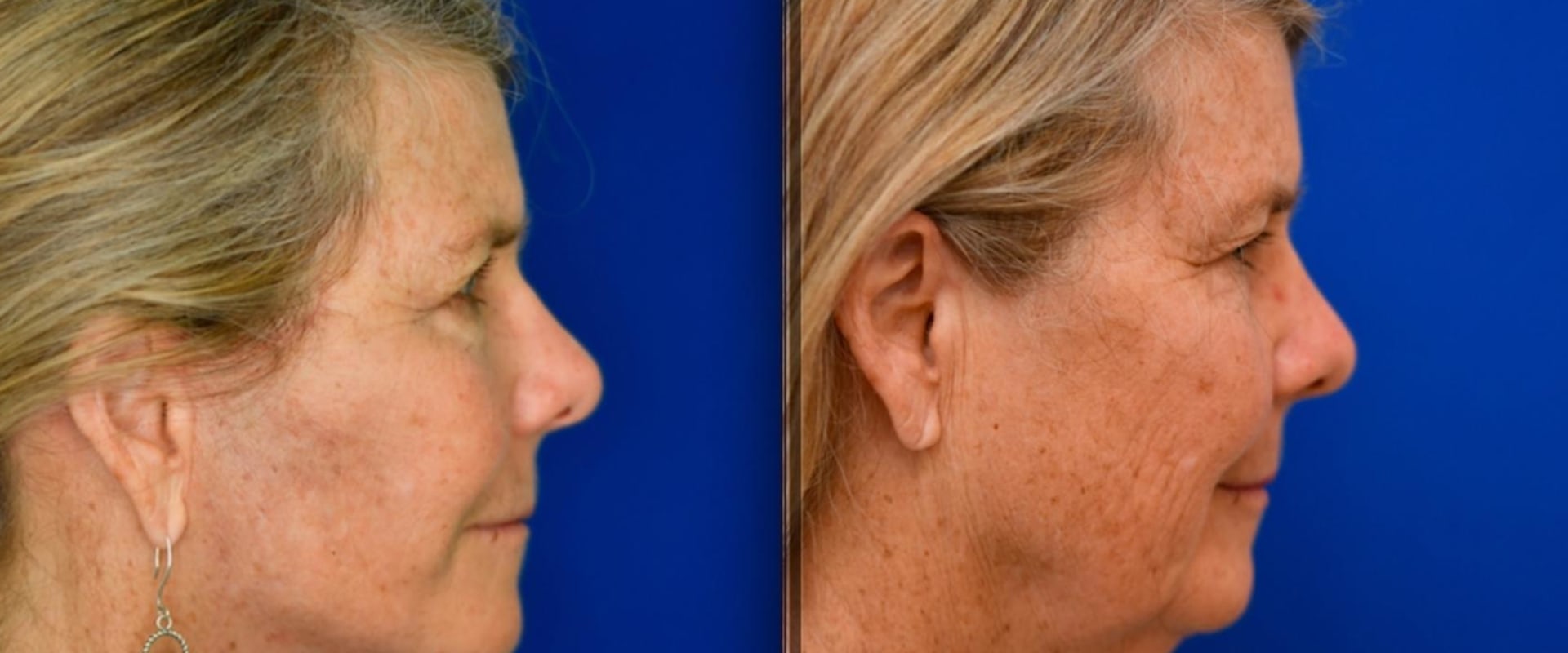 The True Cost of a Facelift: What You Need to Know