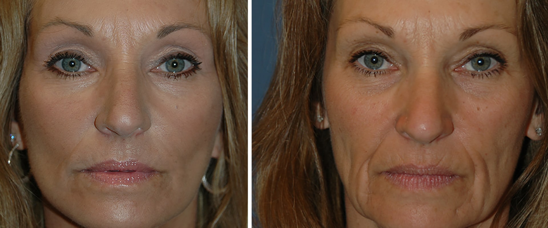 Is it normal for your face to be numb after a facelift?