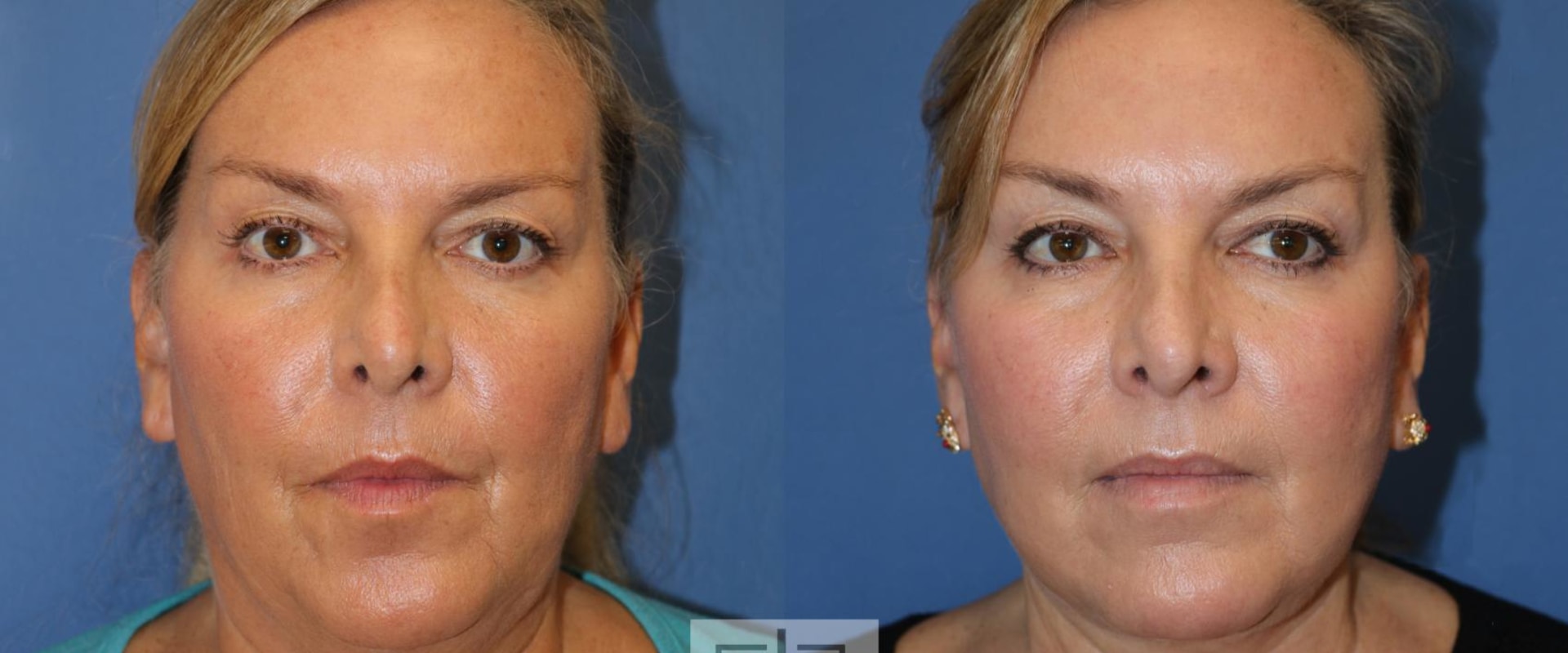 The Longevity of a Facelift: How Long Can You Expect Your Results to Last?