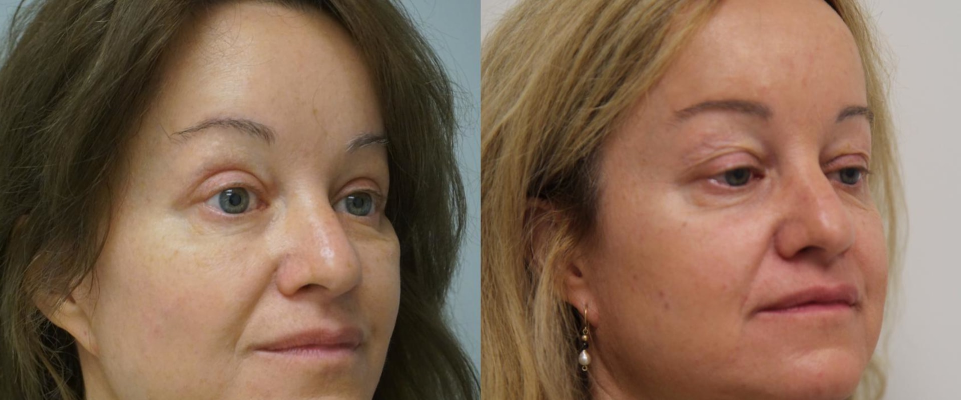 What is the best face lift surgery?