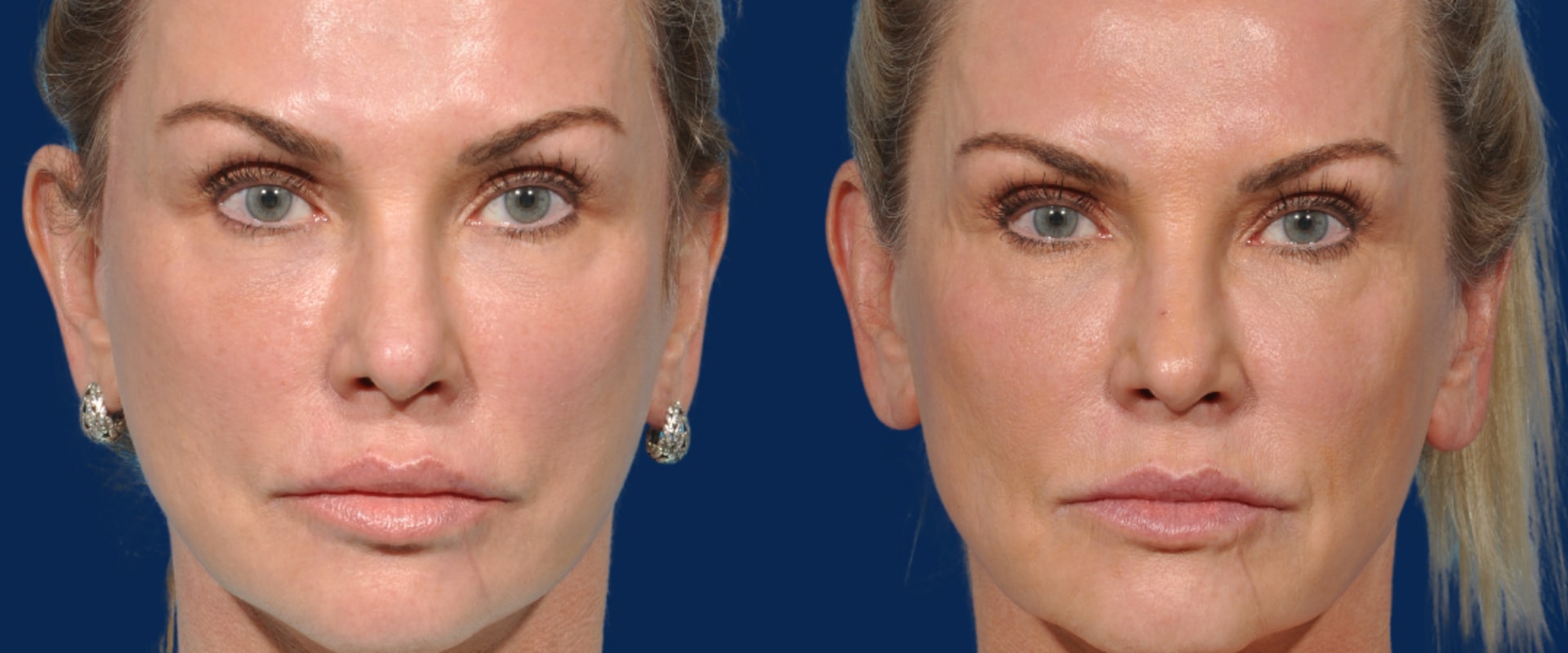 How do you know if you need a mini facelift?