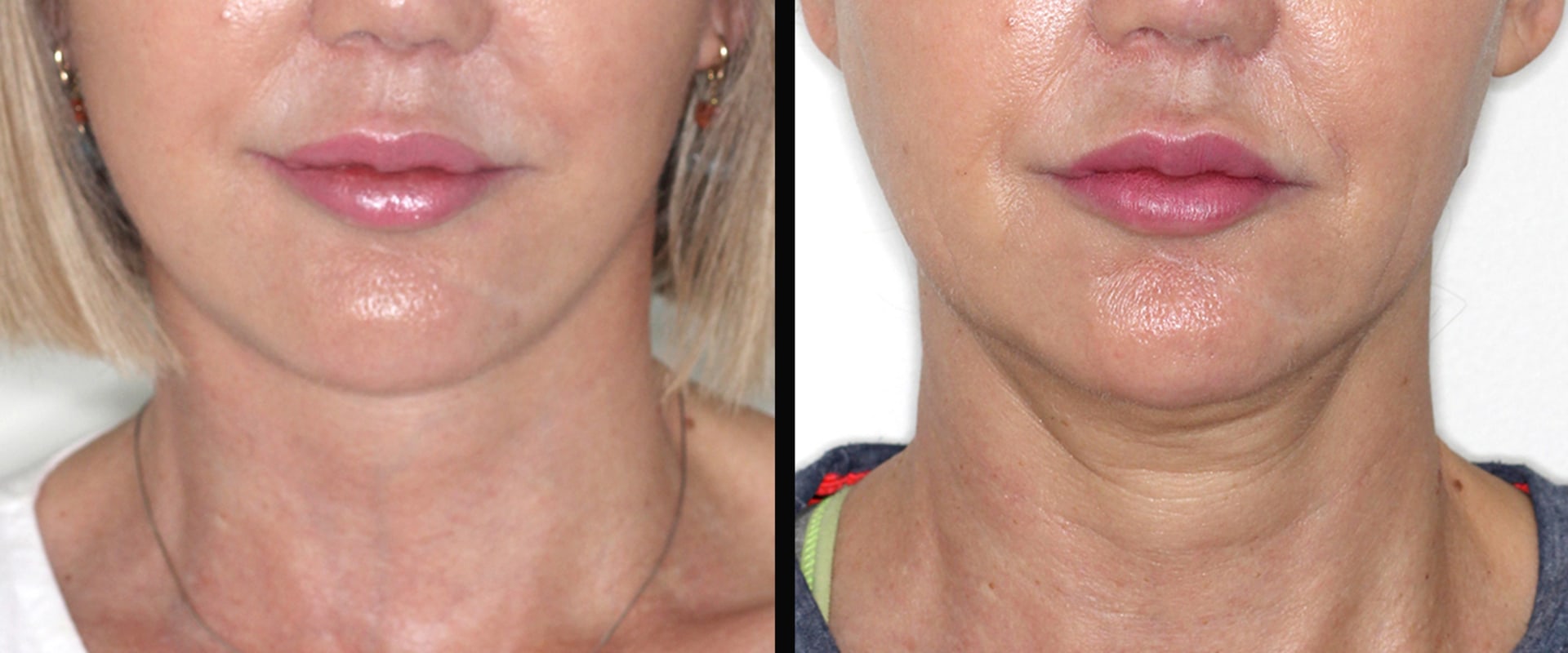 What age is deep plane facelift for?