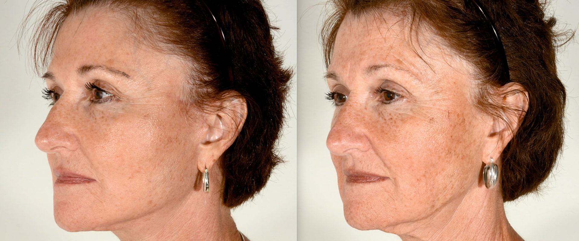 Can you get a facelift multiple times?