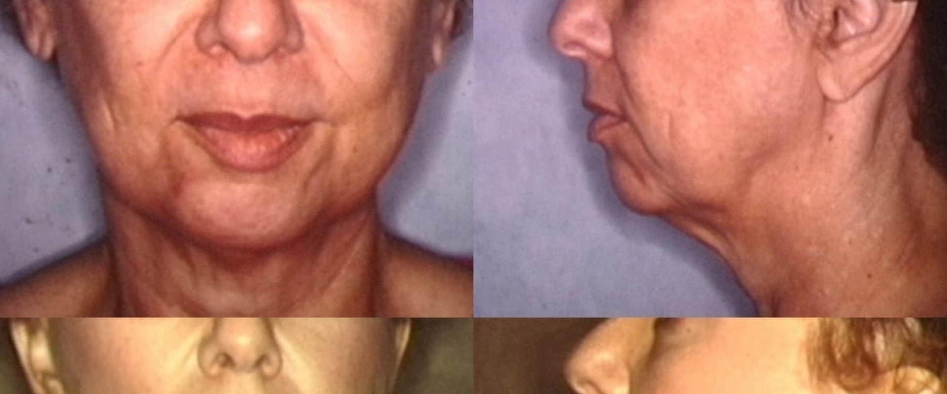 The Longevity of Facelift Results: How to Maximize and Preserve Your Youthful Appearance