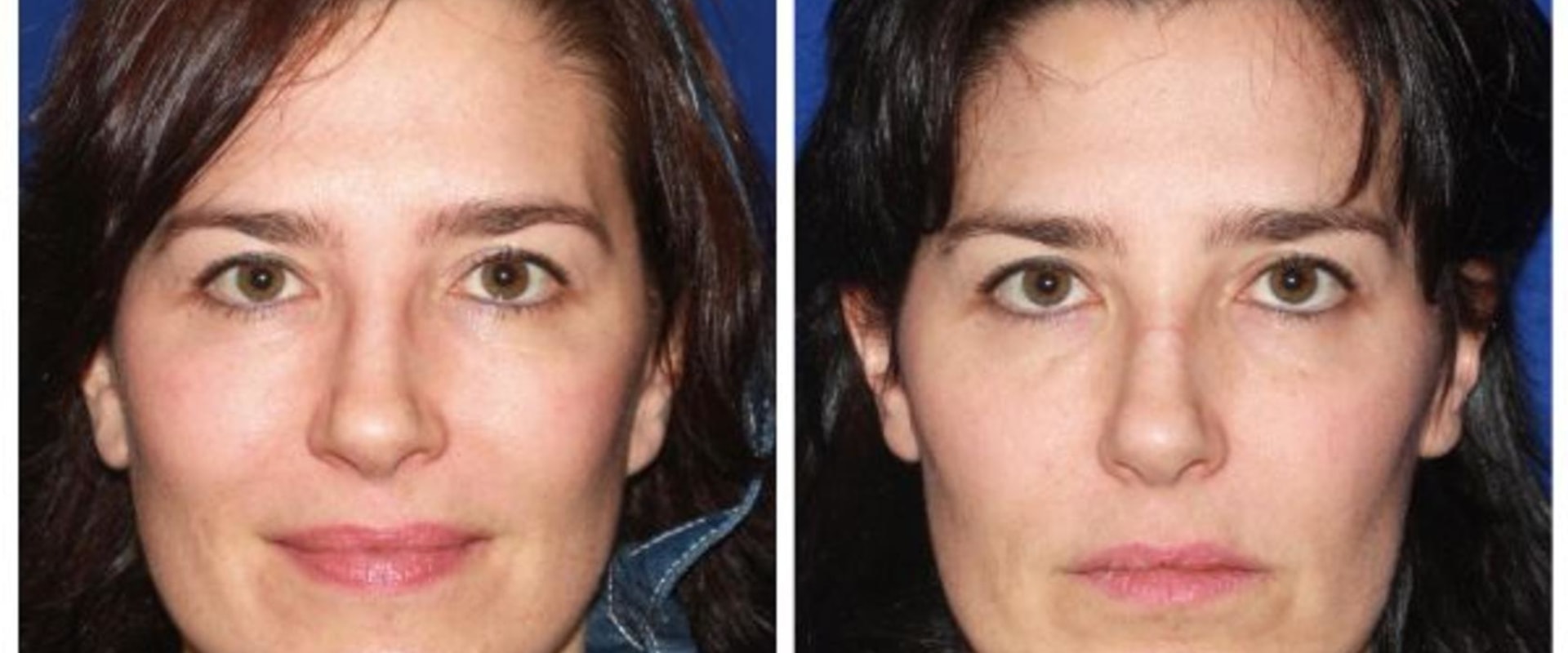 The Benefits of Mini Facelifts for Younger Patients