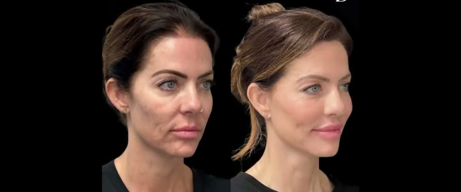 The Ultimate Guide to Facelift Surgery in Tampa, Florida: What You Need to Know