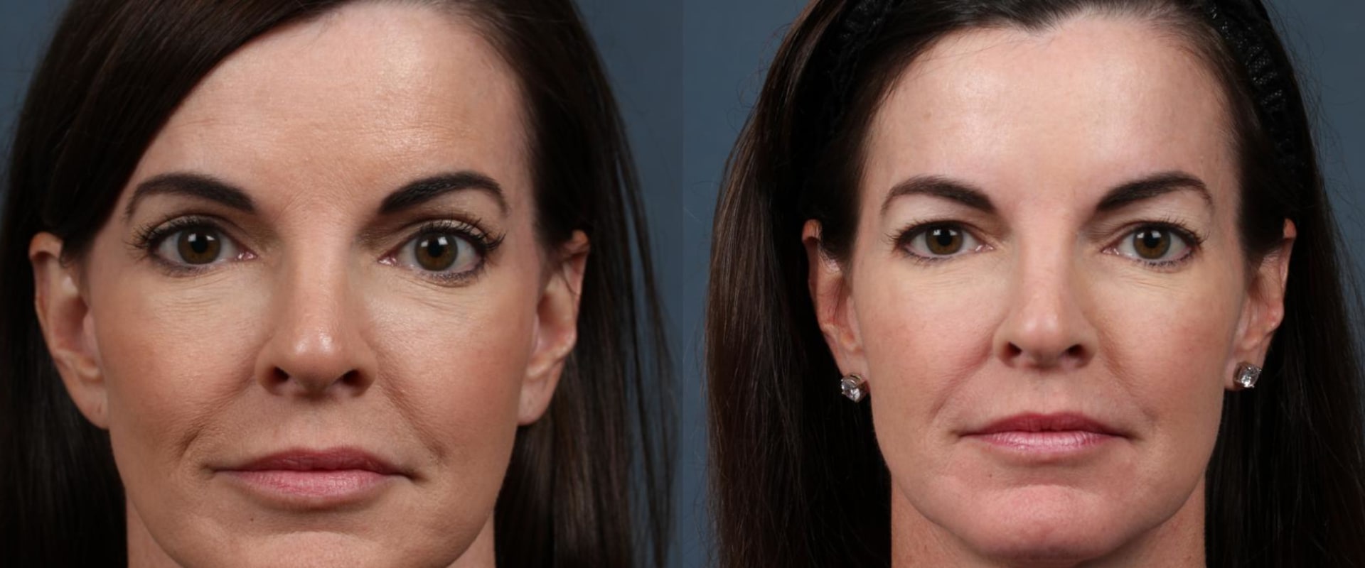 The Ideal Age for a Facelift: Expert Insights