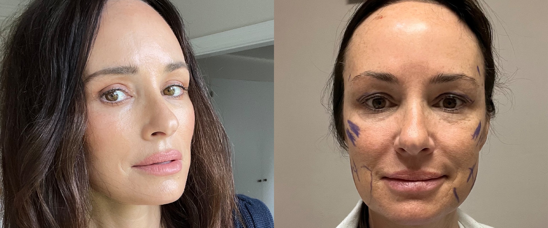 Is it safe to have a second facelift?