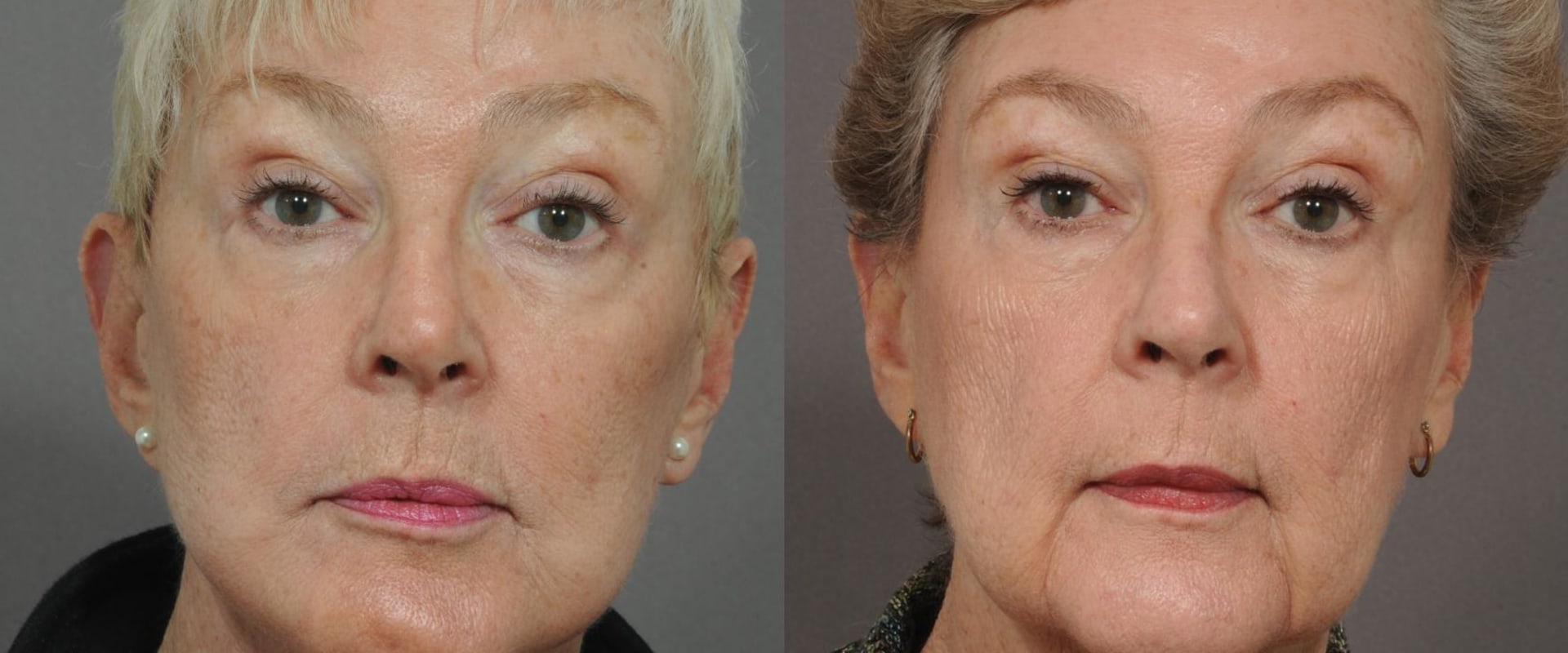 Is 72 too old for a brow lift?