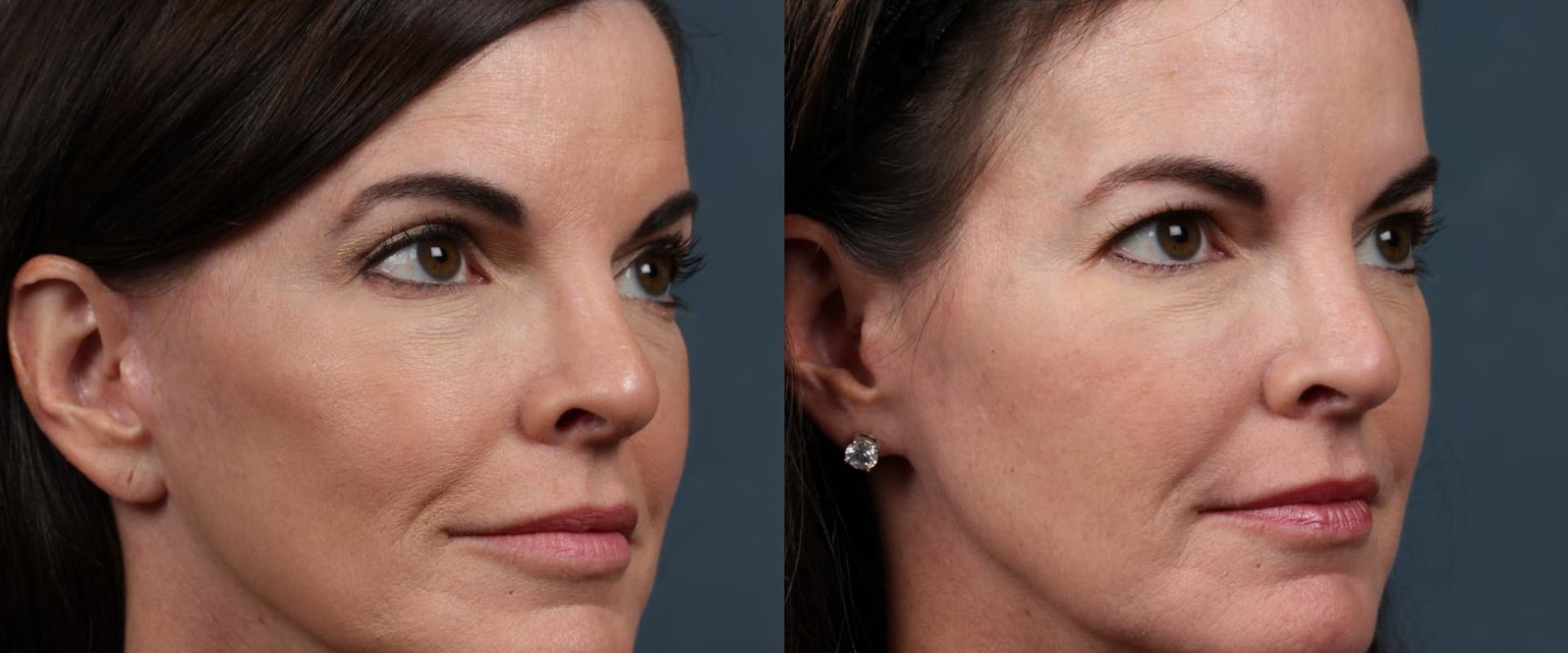 The Truth About Facelifts: Debunking Myths and Exploring the Transformative Effects