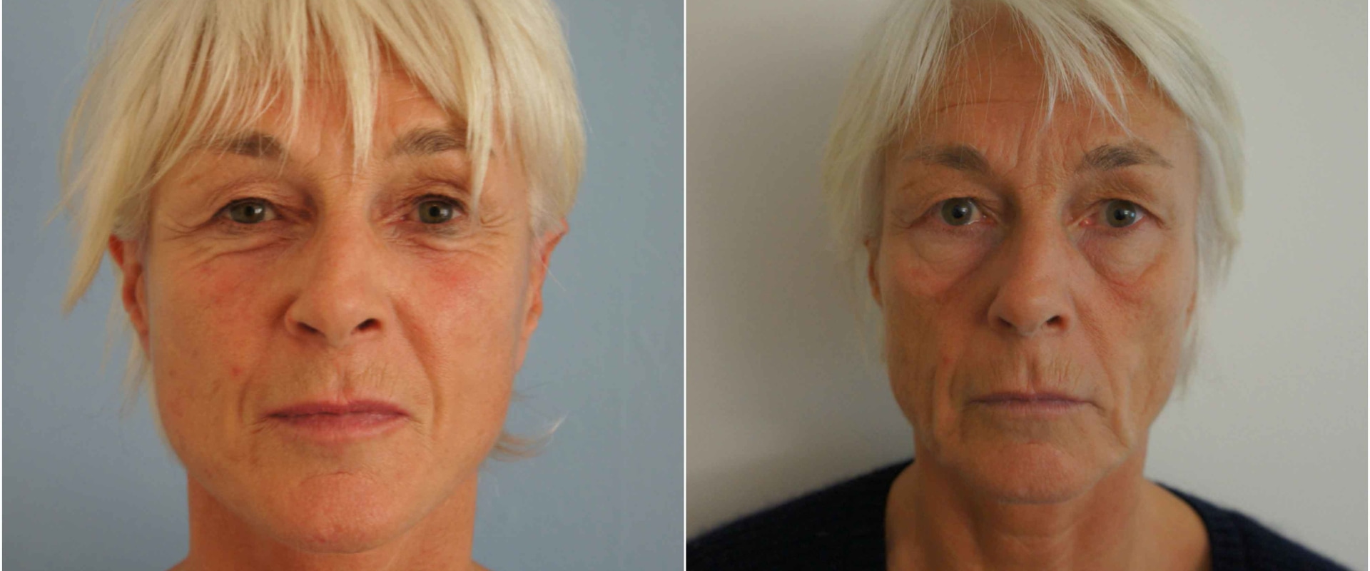 The Ultimate Guide to Facelift Costs in the UK