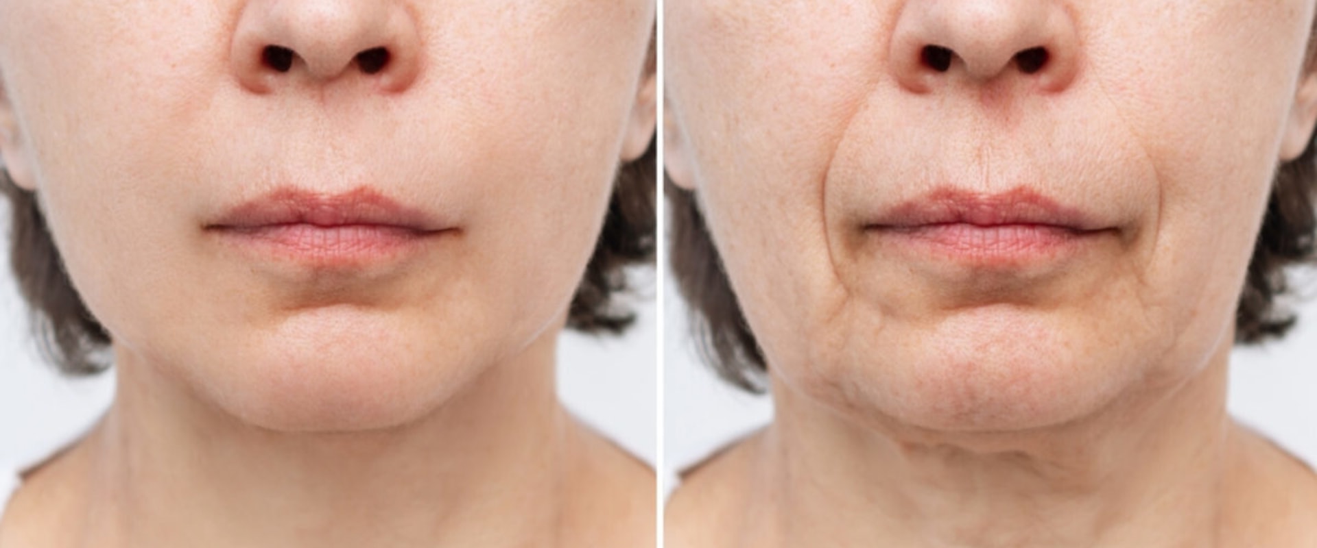 The Longevity of a Facelift: How Long Can You Expect Your Results to Last?