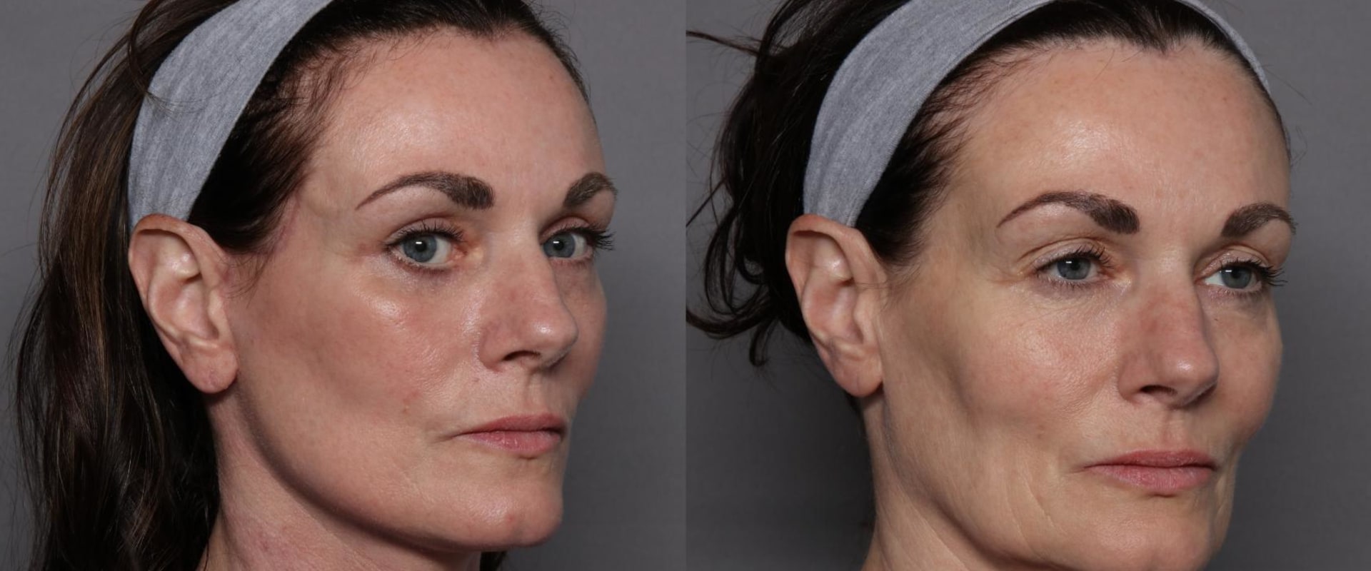 The Secret to Long-Lasting Facelifts