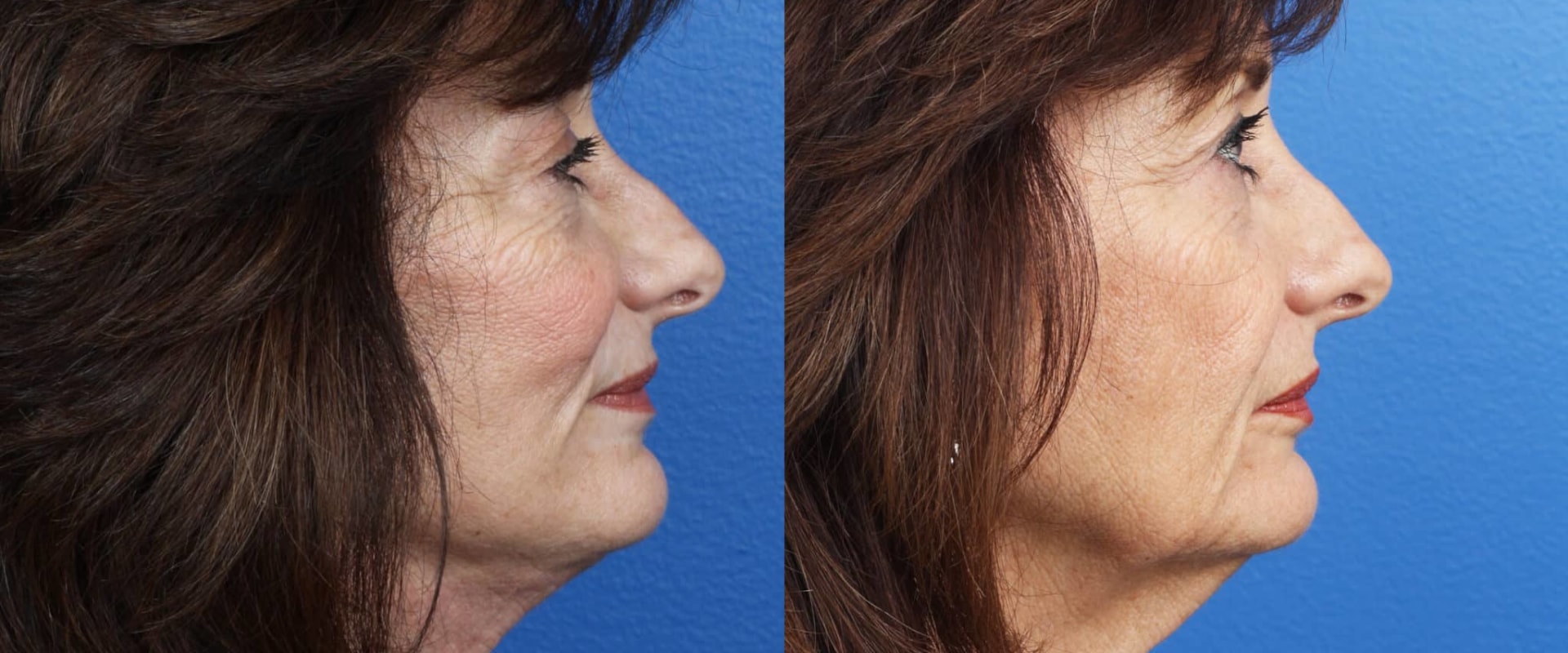 Can you tell if someone has had a face lift?