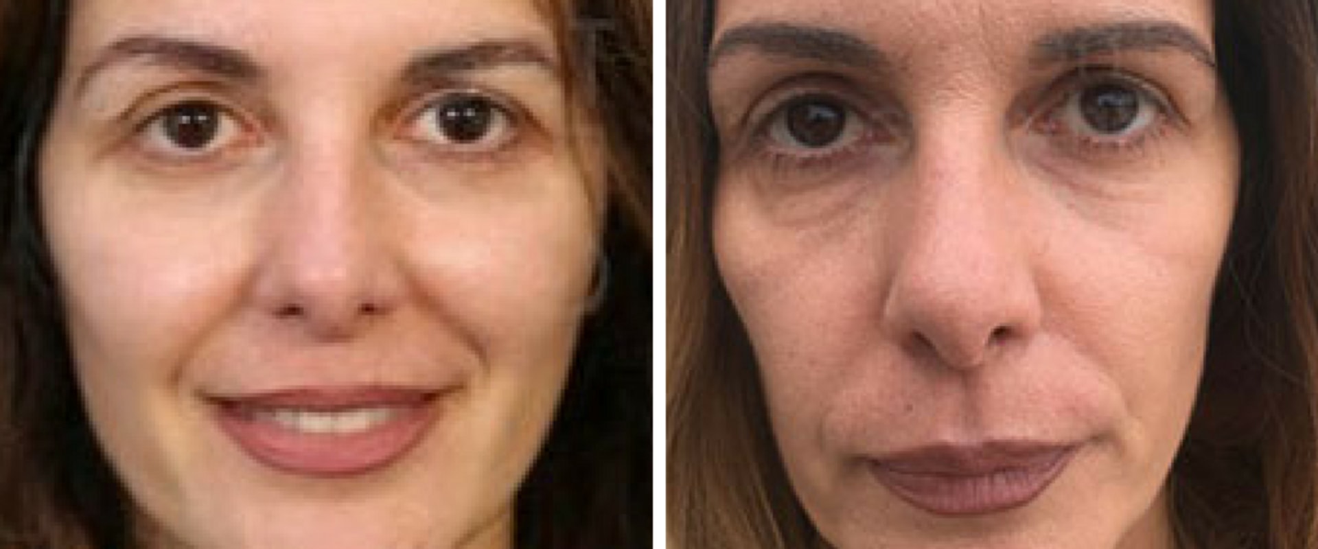 The Benefits of a Mini Facelift