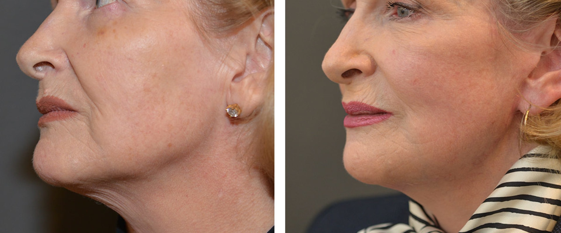 The Truth About Facelifts: Debunking the Myths and Revealing the Facts