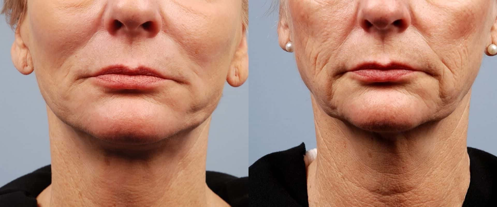 What is the most advanced non-invasive face lift?