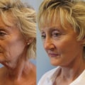 How Much Does a Full Facelift Cost in Florida?