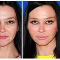 The Cost of a Facelift: What You Need to Know