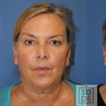 The Secret to Long-Lasting Facelift Results