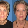 What is the Best Age to Have a Facelift?