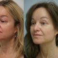 The Ultimate Guide to Affordable Facelift Options: An Expert's Perspective