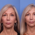 Can cosmetic surgery make you look younger?