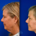 The True Cost of a Facelift: What You Need to Know