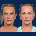 How do you know if you need a mini facelift?