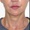 What age is deep plane facelift for?