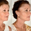 Can you get a facelift multiple times?