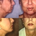 The Longevity of Facelift Results: How to Maximize and Preserve Your Youthful Appearance