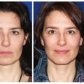 The Benefits of Mini Facelifts for Younger Patients