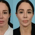 The Ideal Age for a Facelift: Expert Insights