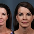 The Ideal Age for a Facelift: Expert Insights