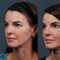 The Truth About Facelifts: Debunking Myths and Exploring the Transformative Effects