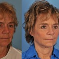 How Long Before a Facelift Looks Natural?
