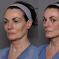 The Secret to Long-Lasting Facelifts