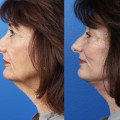 Can you tell if someone has had a face lift?