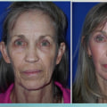 The Power of Facelifts: How Plastic Surgery Can Make You Look 20 Years Younger