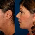 Where is the Best Place to Get a Facelift at an Affordable Price?