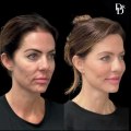 The Ultimate Guide to Facelift Surgery in Tampa