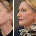 The Truth About Facelifts: Debunking the Myths and Revealing the Facts