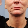 What is the most advanced non-invasive face lift?