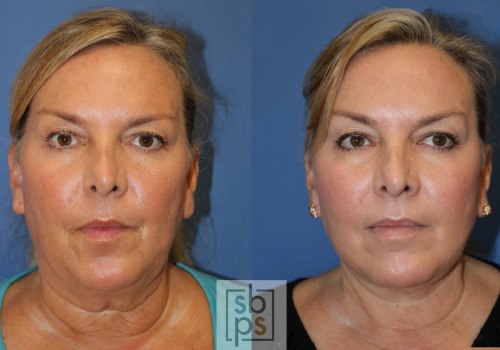 The Secret to Long-Lasting Facelift Results