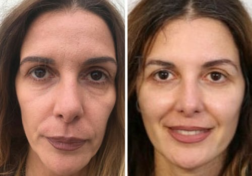 What is the best non-invasive facelift for 2023?