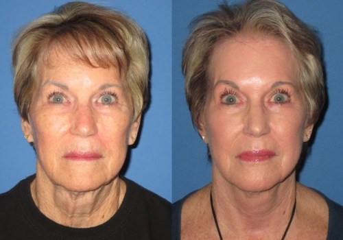 What is the Best Age to Have a Facelift?