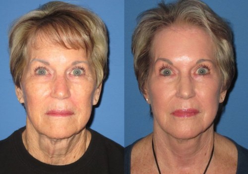 Is 70 too old for face-lift?